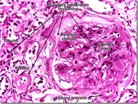 Pathology of Common Glomerular Diseases